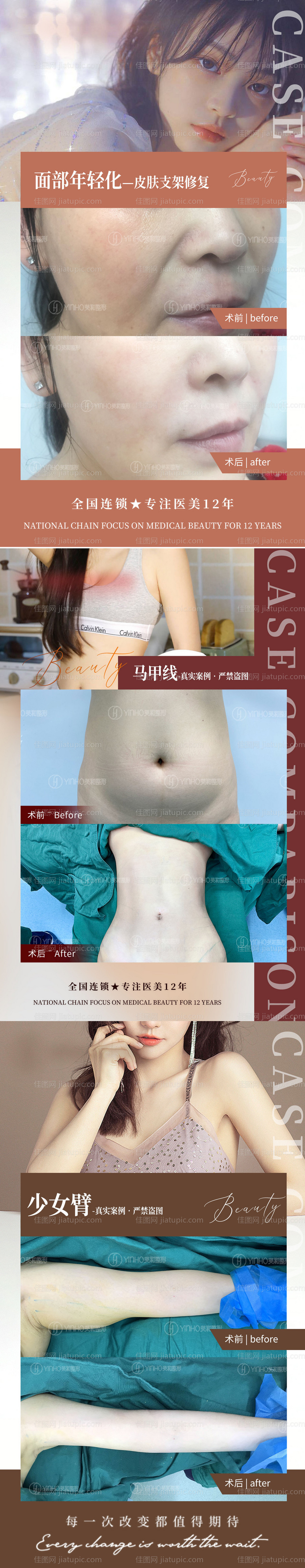 医美案例对比图系列海报-源文件